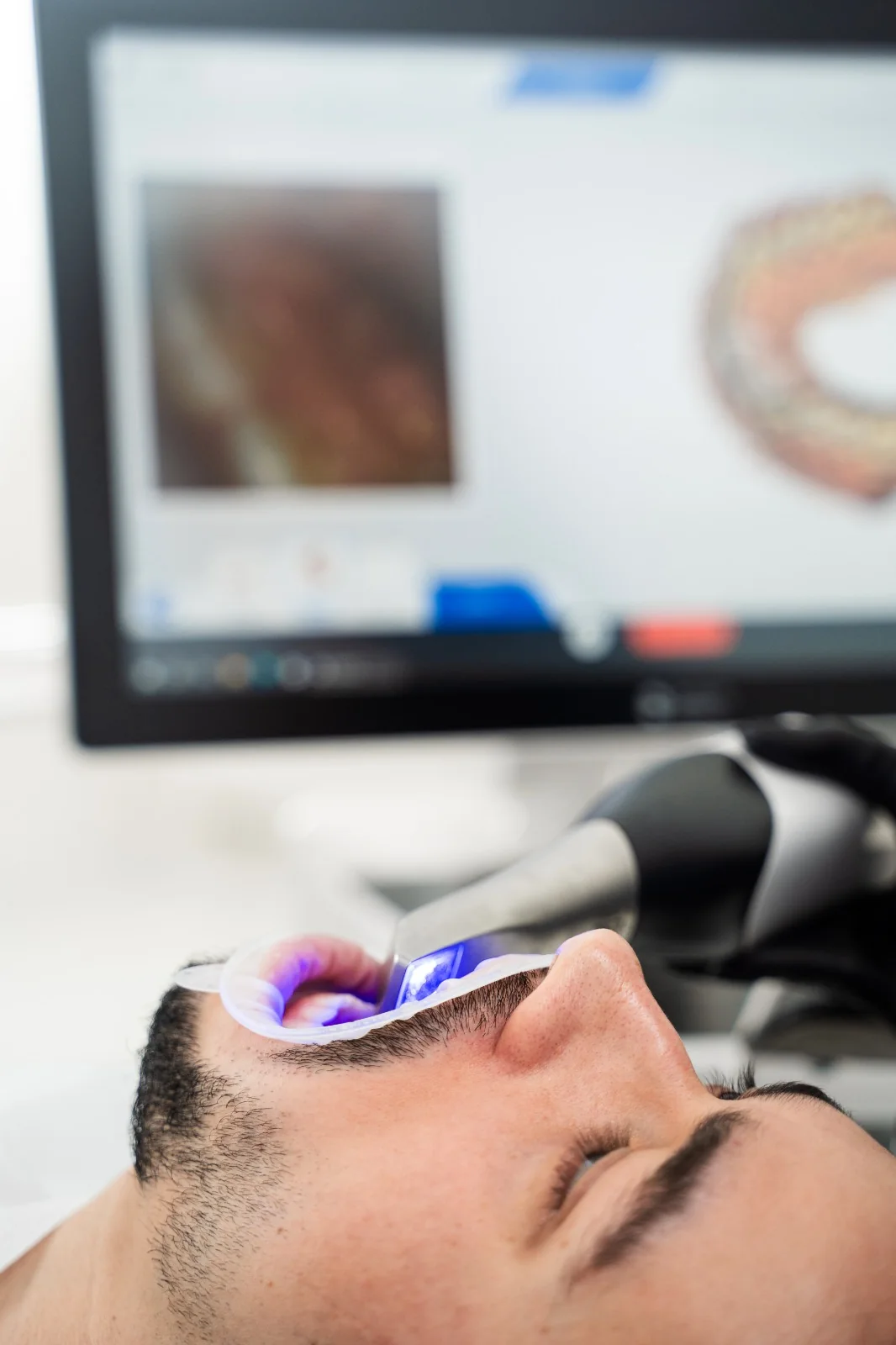 Prise d’une empreinte numérique avec un scanner intra-oral